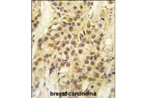 Formalin-fixed and paraffin-embedded human breast carcinoma tissue reacted with HMOF/MYST1 antibody , which was peroxidase-conjugated to the secondary antibody, followed by DAB staining. (MYST1 anticorps  (C-Term))
