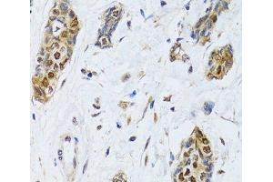 Immunohistochemistry of paraffin-embedded Human breast cancer using CIRBP Polyclonal Antibody at dilution of 1:100 (40x lens). (CIRBP anticorps)