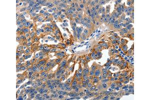Immunohistochemistry of Human ovarian cancer using CLDN1 Polyclonal Antibody at dilution of 1:150 (Claudin 1 anticorps)