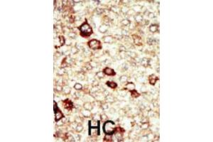 Formalin-fixed and paraffin-embedded human hepatocellular carcinoma tissue reacted with FGFR4 polyclonal antibody  , which was peroxidase-conjugated to the secondary antibody, followed by AEC staining. (FGFR4 anticorps  (N-Term))