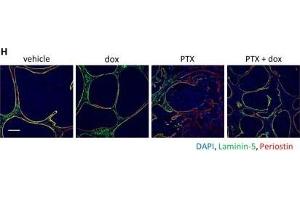 Periostin is required for mesenchymal cell expansion and tumor invasion in residual tumors upon chemotherapy.