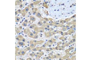 Immunohistochemistry of paraffin-embedded human liver cancer using GFM1 antibody. (GFM1 anticorps  (AA 482-751))