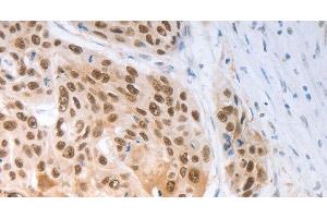 Immunohistochemistry of paraffin-embedded Human ovarian cancer tissue using SLC22A8 Polyclonal Antibody at dilution 1:70 (SLC22A8 anticorps)