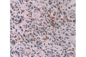 IHC-P analysis of stomach cancer tissue, with DAB staining. (OAS1 anticorps  (AA 74-165))