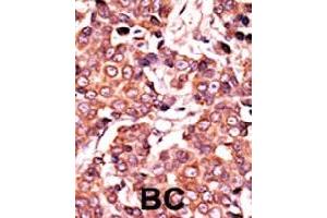 Formalin-fixed and paraffin-embedded human cancer tissue reacted with CDC25A (phospho S278) polyclonal antibody  which was peroxidase-conjugated to the secondary antibody followed by AEC staining. (CDC25A anticorps  (pSer279))