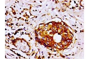 Immunohistochemistry of paraffin-embedded human breast cancer using ABIN7152944 at dilution of 1:100