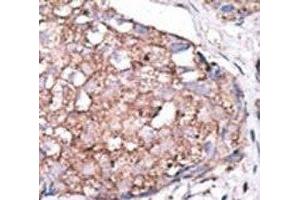IHC analysis of FFPE human hepatocarcinoma stained with the SIGLEC7 antibody (SIGLEC7 anticorps  (AA 407-438))