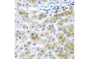 Immunohistochemistry of paraffin-embedded human liver cancer using RARRES2 antibody.