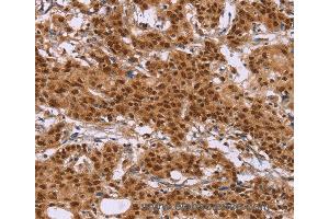 Immunohistochemistry of Human liver cancer using CTNNBL1 Polyclonal Antibody at dilution of 1:50 (CTNNBL1 anticorps)