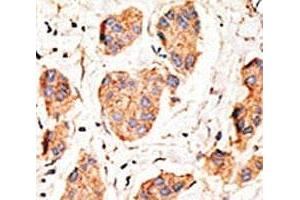 IHC analysis of FFPE human breast carcinoma tissue stained with the Connexin 43 antibody