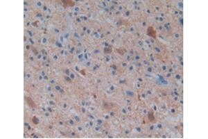 IHC-P analysis of Human Glioma Tissue, with DAB staining. (ENO2/NSE anticorps  (AA 1-434))