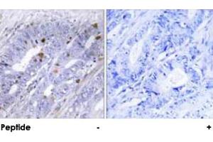 Immunohistochemical analysis of paraffin-embedded human colon carcinoma tissue using NR4A1 polyclonal antibody . (NR4A1 anticorps)