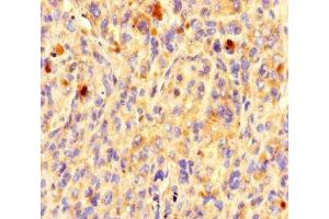 Immunohistochemistry of paraffin-embedded human melanoma using ABIN7162191 at dilution of 1:100 (OR5L1 anticorps  (AA 161-196))