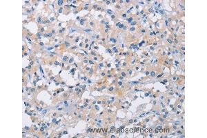 Immunohistochemistry of Human thyroid cancer using ATP6AP2 Polyclonal Antibody at dilution of 1:50 (ATP6AP2 anticorps)
