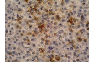 Immunohistochemistry of paraffin-embedded sections (hepatocellular carcinoma) Immunohistochemistry staining of hepatocellular carcinoma (fetal liver; paraffin-embedded sections) with anti-human alpha-Fetoprotein (AFP-11). (alpha Fetoprotein anticorps)