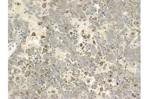 ABIN6257409 and ABIN6273693 at 1/100 staining human melanoma by IHC-P. (PAK1IP1 anticorps  (C-Term))