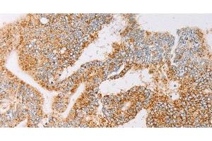 Immunohistochemistry of paraffin-embedded Human colon cancer tissue using YARS2 Polyclonal Antibody at dilution 1:30 (YARS2 anticorps)