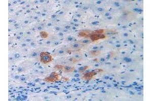 IHC-P analysis of Human Liver Cancer Tissue, with DAB staining. (Relaxin 2 anticorps  (AA 1-186))