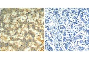 Immunohistochemical analysis of paraffin-embedded human breast carcinoma tissue using syk (phospho-Tyr323) Antibody (E011546). (SYK anticorps  (pTyr323))