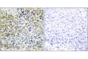 Immunohistochemistry analysis of paraffin-embedded human liver carcinoma tissue, using CARKL Antibody.