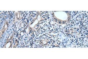 Immunohistochemistry of paraffin-embedded Human cervical cancer tissue using USP32 Polyclonal Antibody at dilution of 1:75(x200) (USP32 anticorps)