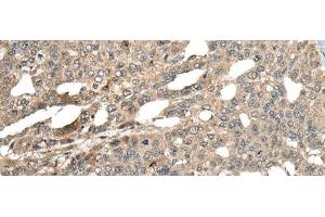 Immunohistochemistry of paraffin-embedded Human liver cancer tissue using MCPH1 Polyclonal Antibody at dilution of 1:110(x200) (MCPH1 anticorps)