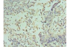 Immunohistochemistry of paraffin-embedded human cervical cancer using ABIN7153389 at dilution of 1:100