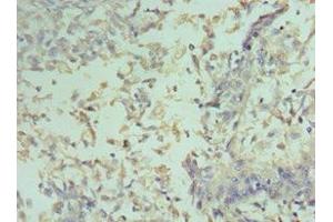 Immunohistochemistry of paraffin-embedded human cervical cancer using ABIN7153389 at dilution of 1:100 (Cyclin D2 anticorps  (AA 1-289))