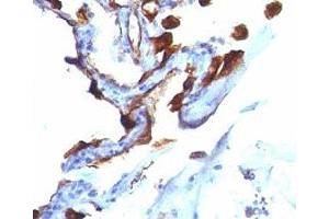 Formalin-fixed, paraffin-embedded human lung carcinoma stained with Cytokeratin 8 + 18 antibody (C-51). (Cytokeratin 8/18 anticorps)
