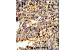 Formalin-fixed and paraffin-embedded human lung carcinoma reacted with FCGR2C Antibody (C-term), which was peroxidase-conjugated to the secondary antibody, followed by DAB staining. (FCGR2C anticorps  (C-Term))
