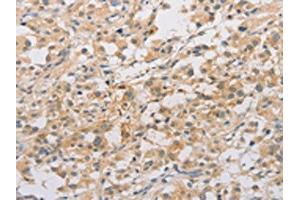 The image on the left is immunohistochemistry of paraffin-embedded Human thyroid cancer tissue using ABIN7128532(ARSF Antibody) at dilution 1/20, on the right is treated with fusion protein. (ARSF anticorps)