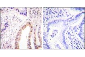 Immunohistochemistry analysis of paraffin-embedded human lung carcinoma, using MEF2D (Phospho-Ser444) Antibody. (MEF2D anticorps  (pSer444))