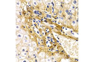 Immunohistochemistry of paraffin-embedded human liver injury using CFH antibody (ABIN5971193) at dilution of 1/200 (40x lens). (Complement Factor H anticorps)