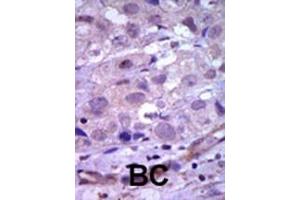 Formalin-fixed and paraffin-embedded human cancer tissue reacted with the primary antibody, which was peroxidase-conjugated to the secondary antibody, followed by AEC staining.