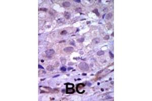 Formalin-fixed and paraffin-embedded human cancer tissue reacted with the primary antibody, which was peroxidase-conjugated to the secondary antibody, followed by AEC staining. (Ret Proto-Oncogene anticorps  (N-Term))