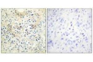 Immunohistochemistry analysis of paraffin-embedded human prostate carcinoma tissue, using TM16G antibody. (Anoctamin 7 anticorps  (C-Term))