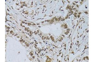 Immunohistochemistry of paraffin-embedded human gastric cancer using EMD antibody. (Emerin anticorps)