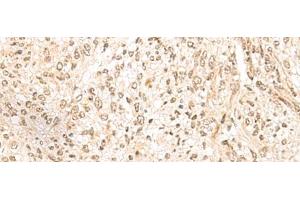 Immunohistochemistry of paraffin-embedded Human liver cancer tissue using MDFI Polyclonal Antibody at dilution of 1:55(x200) (MDFI anticorps)