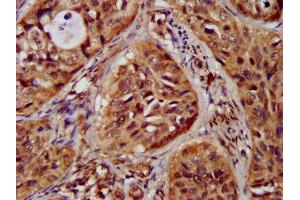 IHC image of ABIN7147960 diluted at 1:300 and staining in paraffin-embedded human cervical cancer performed on a Leica BondTM system. (ST3GAL4 anticorps  (AA 39-184))