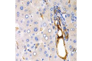 Immunohistochemistry of paraffin-embedded 人human liver cancer using TFF1 antibody at dilution of 1:200 (400x lens). (TFF1 anticorps)