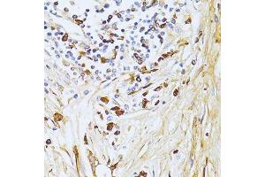 Immunohistochemistry of paraffin-embedded human gastric cancer using TGFBI antibody.