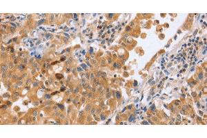 Immunohistochemistry of paraffin-embedded Human lung cancer tissue using BLNK Polyclonal Antibody at dilution 1:50