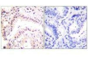 Immunohistochemical analysis of paraffin-embedded human lung carcinoma tissue using Cullin 2 antibody.