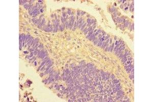 Immunohistochemistry of paraffin-embedded human ovarian cancer using ABIN7148641 at dilution of 1:100