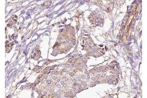 ABIN6273030 at 1/100 staining Human breast cancer tissue by IHC-P. (AFG3L2 anticorps  (C-Term))