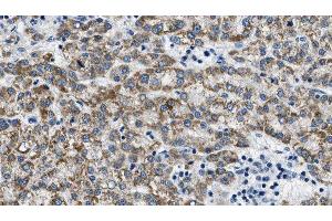 ABIN6275386 at 1/100 staining Human liver cancer tissue by IHC-P. (KCNQ4 anticorps  (C-Term))