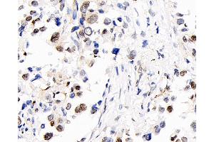Immunohistochemistry analysis of paraffin-embedded human lung cancer using S100A4 Polyclonal Antibody at dilution of 1:400. (s100a4 anticorps)