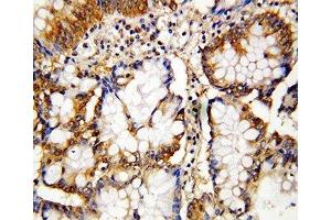 IHC-P: Caspase-10 antibody testing of human intestinal cancer  tissue (Caspase 10 anticorps  (AA 220-236))