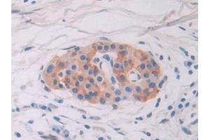 Detection of IFI16 in Human Pancreatic cancer Tissue using Polyclonal Antibody to Interferon Gamma Inducible Protein 16 (IFI16)