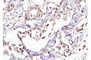 ABIN6276703 at 1/100 staining Human breast cancer tissue by IHC-P. (PICK1 anticorps  (N-Term))